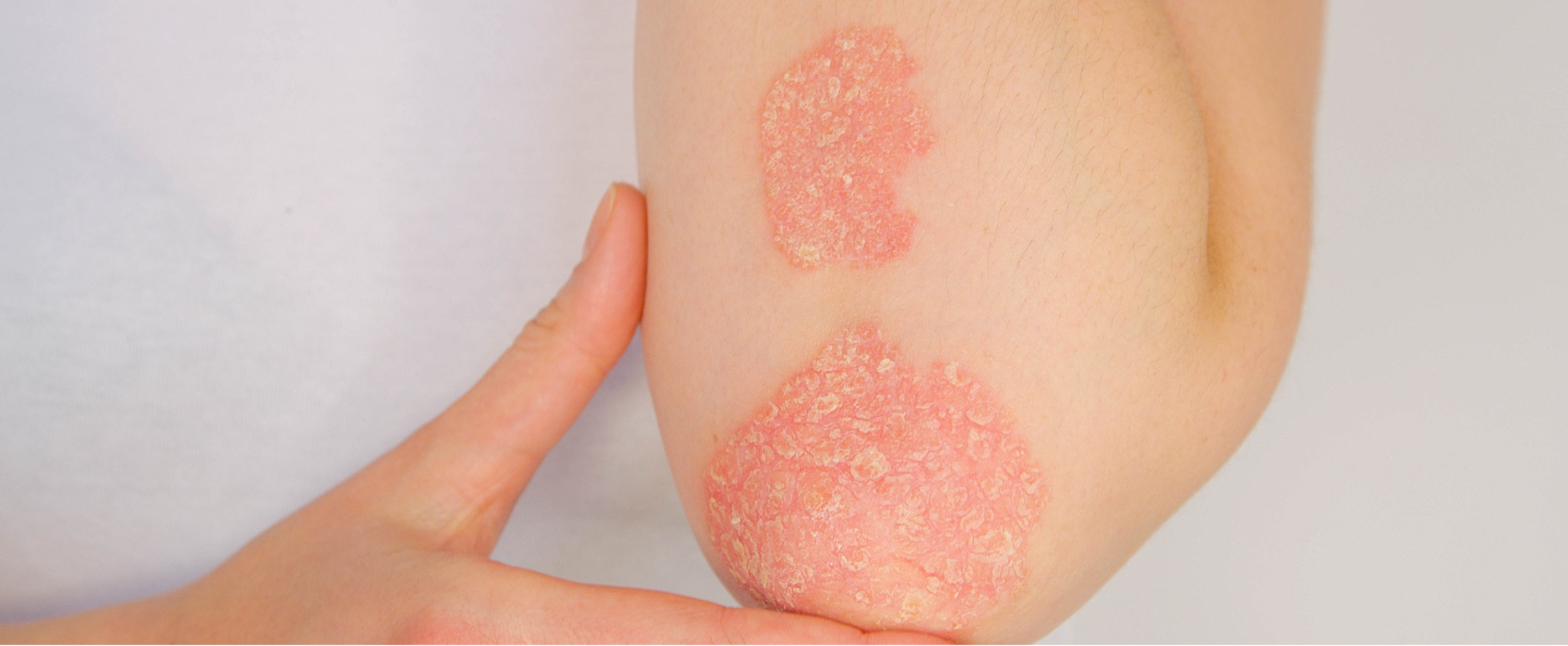 Psoriasis on arm